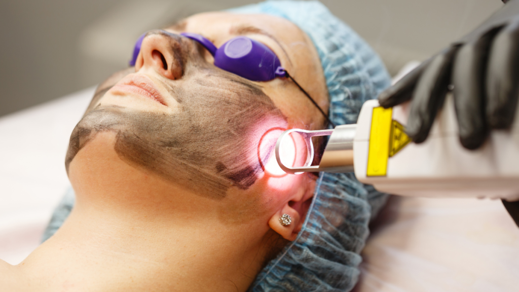 Laser treatment adalah treatment untuk menghilangkan flek hitam